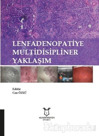 Lenfadenopatiye Multidisipliner Yaklaşım